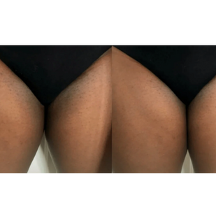 Cuisses et maillots foncés